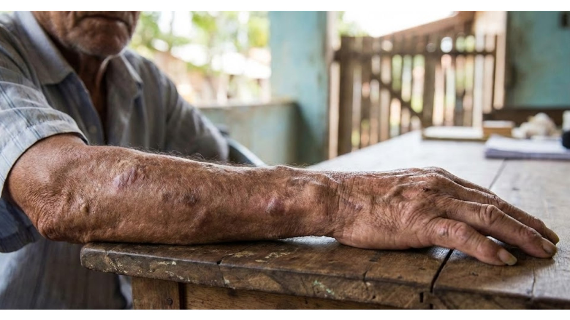 Nakon pojave gube u Hrvatskoj, kakve su šanse da se ova bolest pojavi i u BiH?